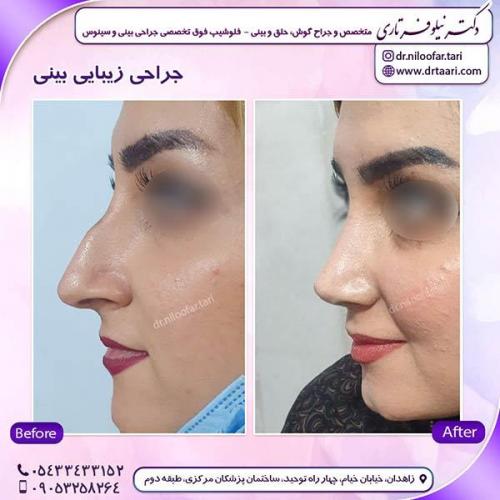 جراحی-بینی-232