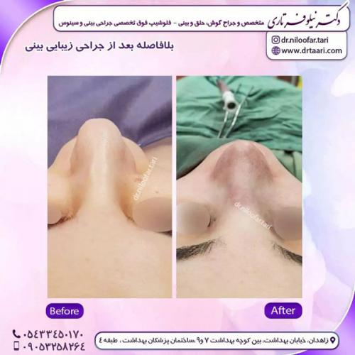 جراحی-بینی-232 (1)
