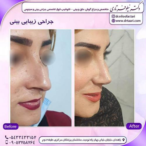 جراحی-بینی-233