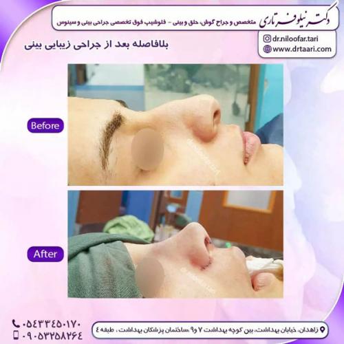 جراحی-بینی-233 (1)