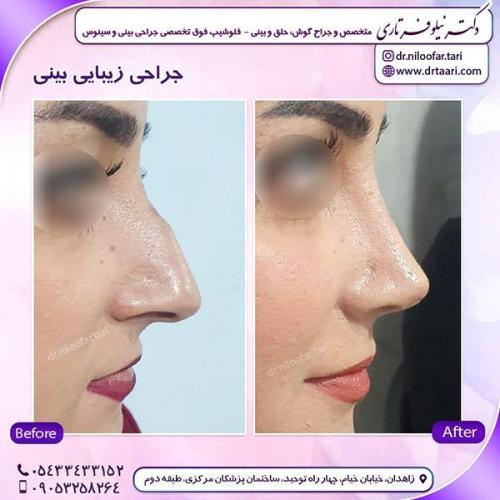 جراحی-بینی-234