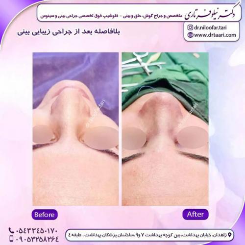 جراحی-بینی-234 (1)