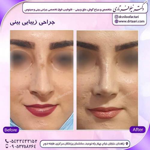 جراحی-بینی-235