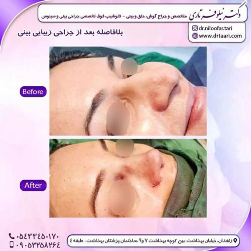 جراحی-بینی-235 (1)