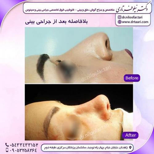 جراحی-بینی-236