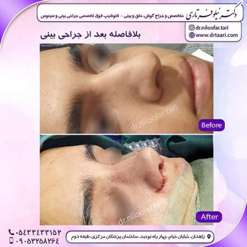 جراحی-بینی-237
