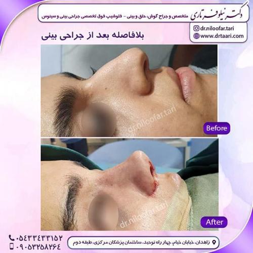 جراحی-بینی-238