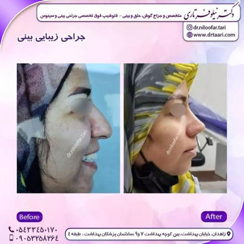 جراحی-بینی-238 (1)