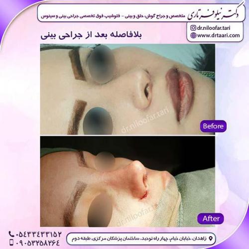 جراحی-بینی-239
