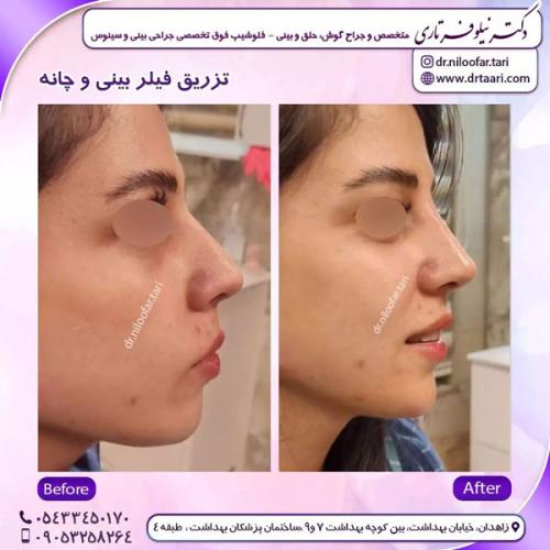 جراحی-بینی-239 (1)