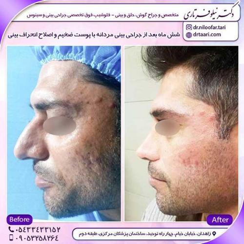 جراحی-بینی-24