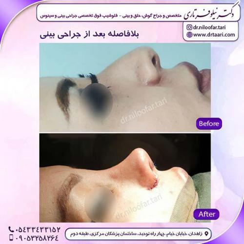 جراحی-بینی-240