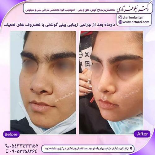 جراحی-بینی-241