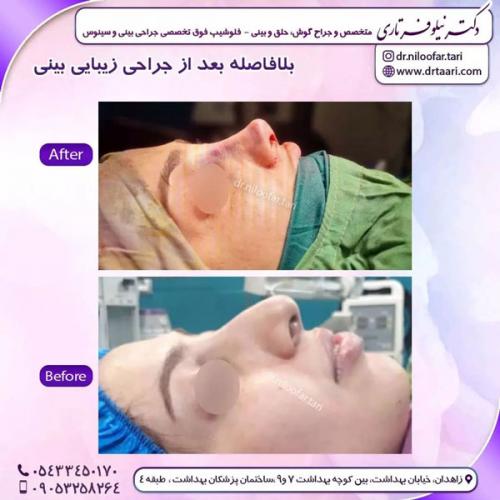 جراحی-بینی-241 (1)