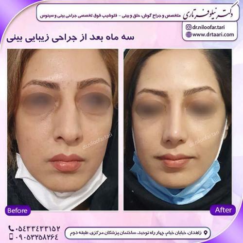 جراحی-بینی-242