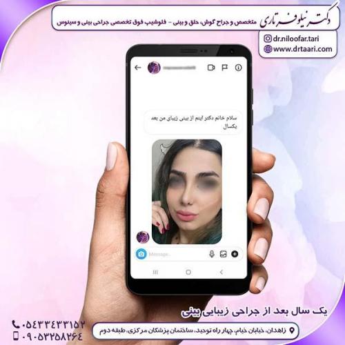 جراحی-بینی-243