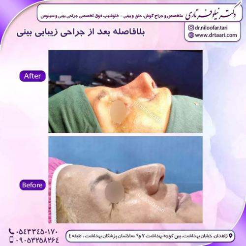 جراحی-بینی-243 (1)