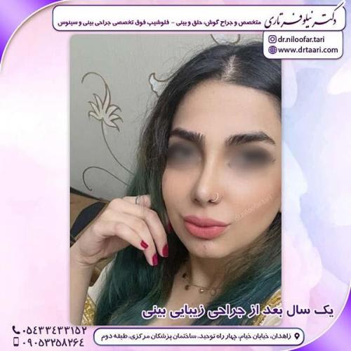 جراحی-بینی-244