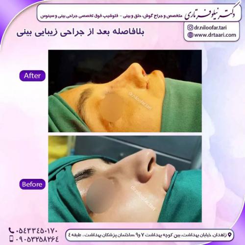 جراحی-بینی-244 (1)