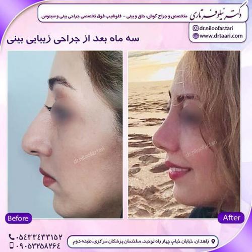 جراحی-بینی-245
