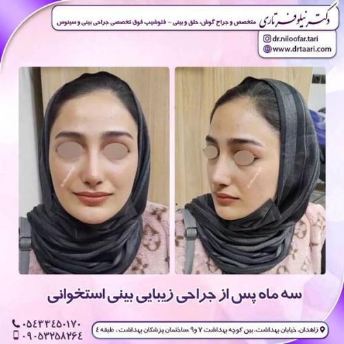 جراحی-بینی-245 (1)