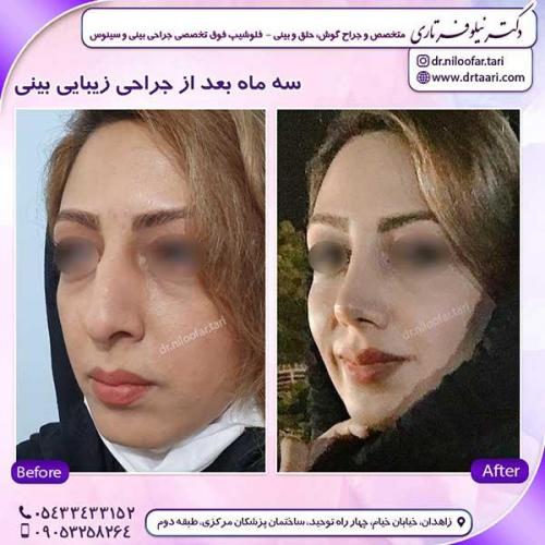 جراحی-بینی-246