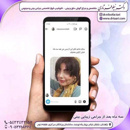 جراحی-بینی-249