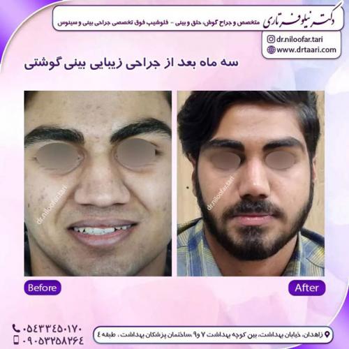 جراحی-بینی-249 (1)