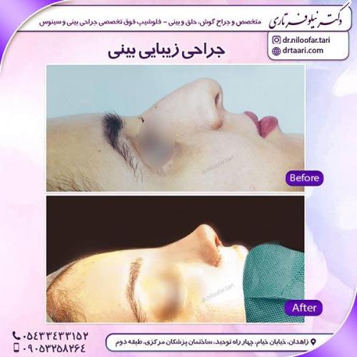 جراحی-بینی-25