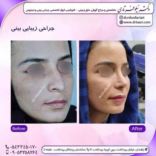 جراحی-بینی-250 (1)