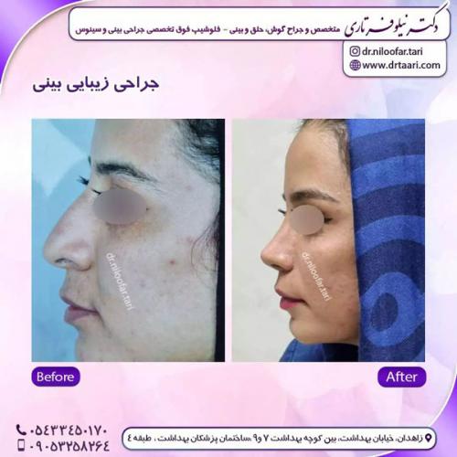 جراحی-بینی-251 (1)