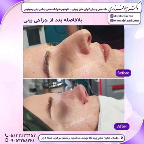 جراحی-بینی-252