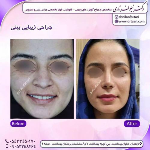 جراحی-بینی-252 (1)