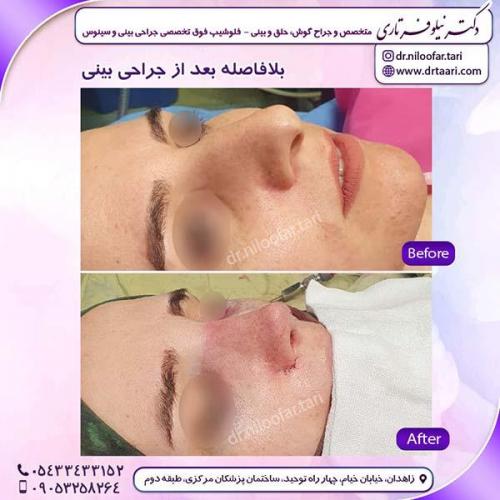 جراحی-بینی-253