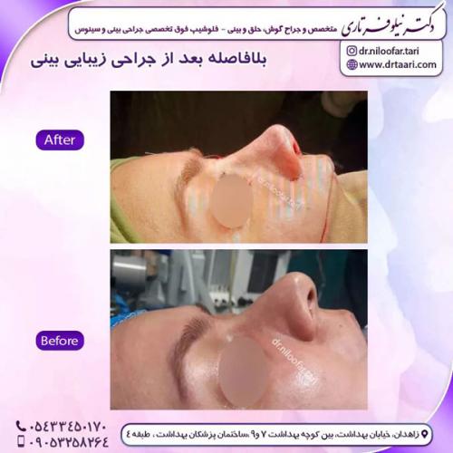 جراحی-بینی-253 (1)