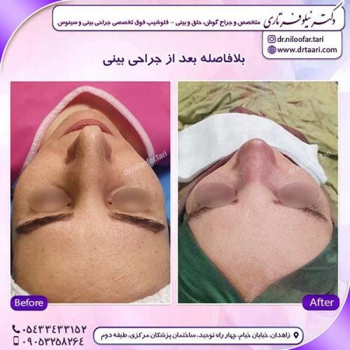 جراحی-بینی-254