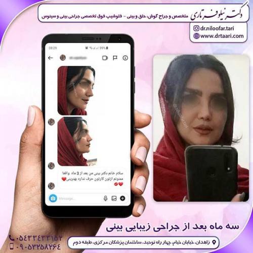 جراحی-بینی-255