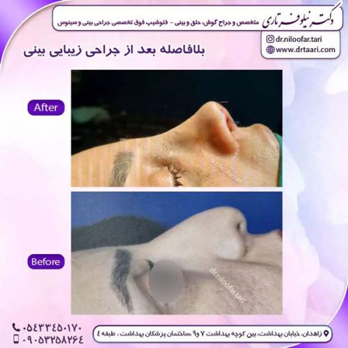 جراحی-بینی-255 (1)