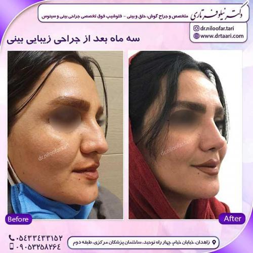 جراحی-بینی-256
