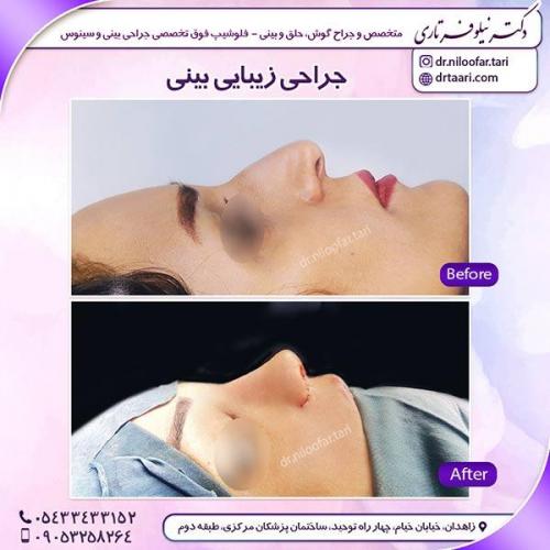 جراحی-بینی-26