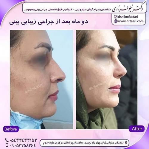 جراحی-بینی-260