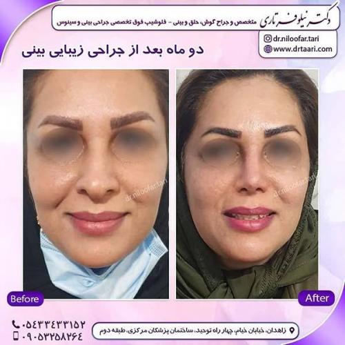 جراحی-بینی-261