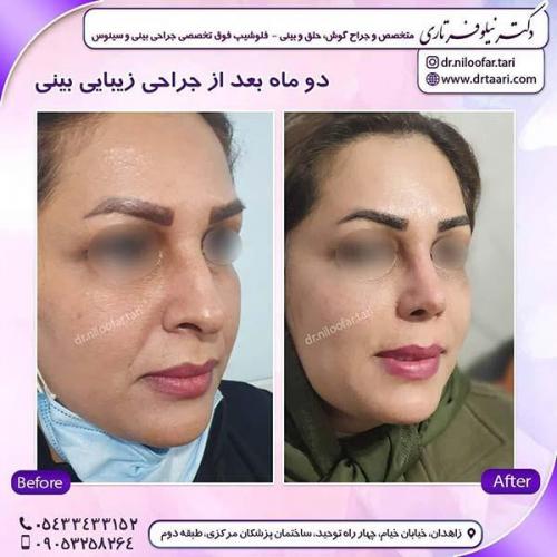 جراحی-بینی-262