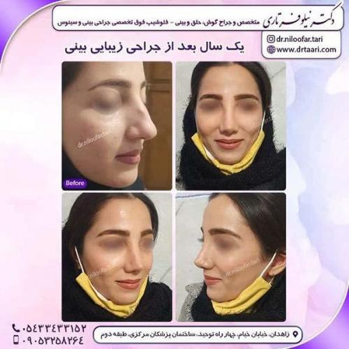 جراحی-بینی-263