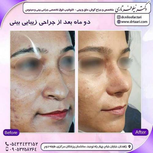 جراحی-بینی-265