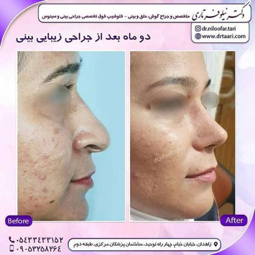 جراحی-بینی-266