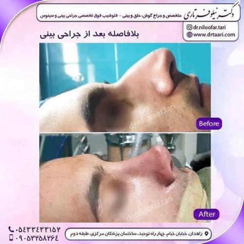 جراحی-بینی-267