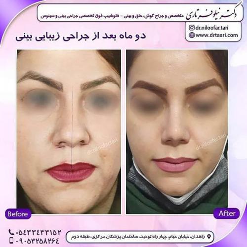جراحی-بینی-268
