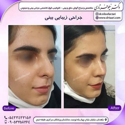 جراحی-بینی-271