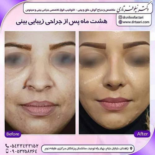 جراحی-بینی-272